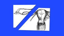 Medical illustration of female reproductive organs; the page has been sliced into two piece, separating the ovaries from the uterus.