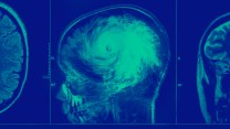 Photo illustration of imaging from a brain CT scan; in one panel a hurricane is in place of where a brain would normally appear.